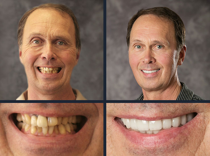An actual patient of Lethbridge cosmetic dentistry before and after dental treatment.