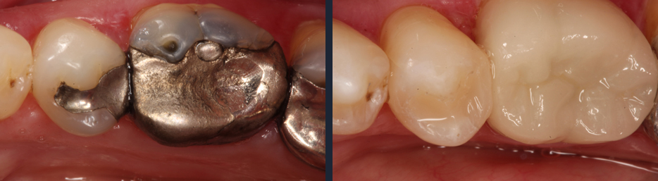 Teeth before and after metal fillings were replaced with non-metal fillings.	