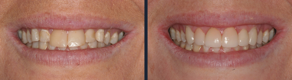 Before and after case study from our cosmetic dentistry expert in Lethbridge	