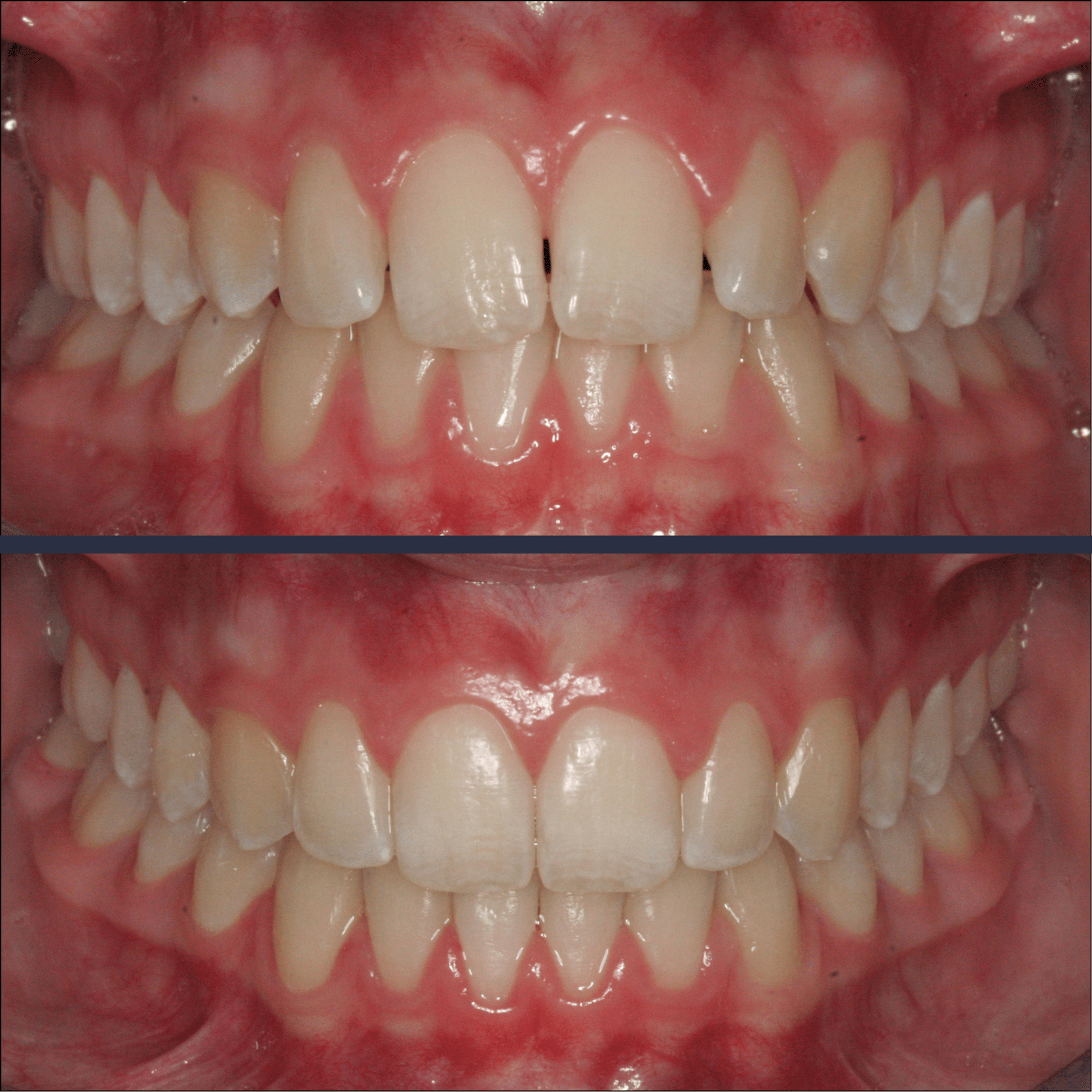 Before and after case study of a patient with Invisalign clear aligners